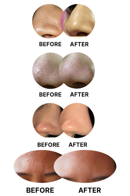 black head remover